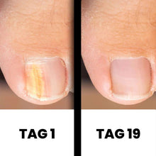 Lade das Bild in den Galerie-Viewer, PureNail - patentierte Nagelpilz-Therapie - für gesunde Nägel innerhalb von 4 Wochen
